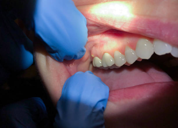 Best Emergency Dentist for Lost Fillings or Crowns in Bellevue, IL